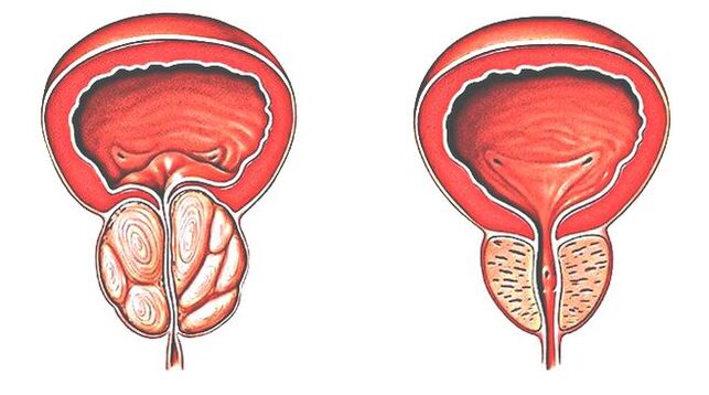 Prostatitis und normale Prostata