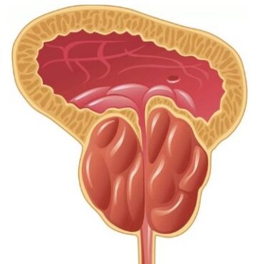 Entzündung der Prostata