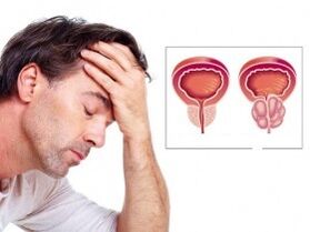 Prostatitis bei einem Mann