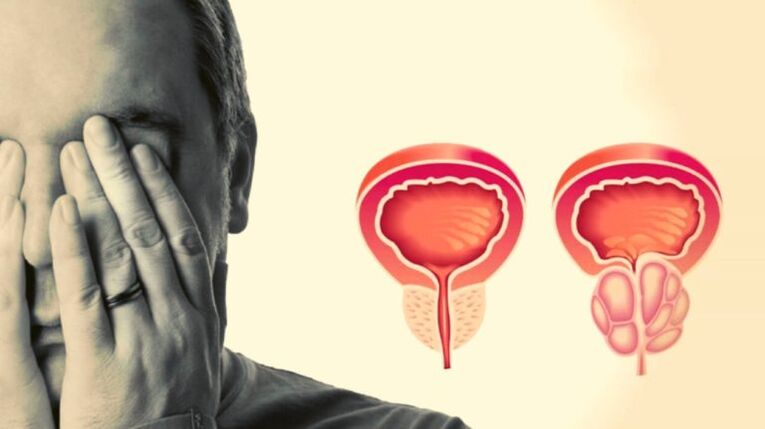 Ein Mann hat Prostatitis