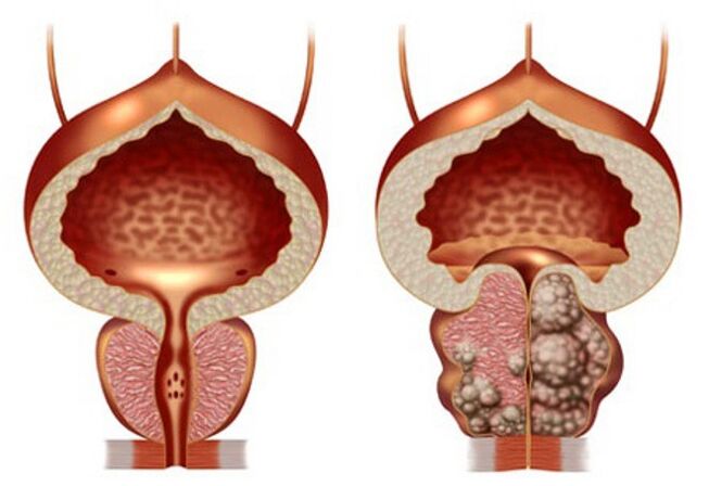 gesunde Prostata und Prostataadenom