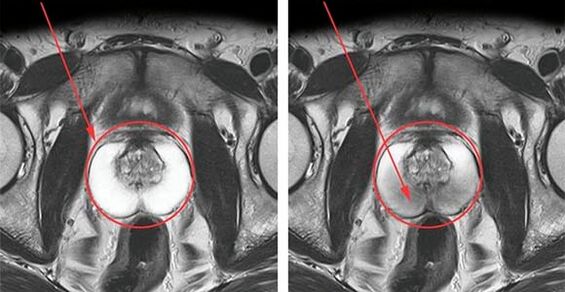 Normale Prostata (links) und Prostataentzündung mit Prostatitis (rechts)